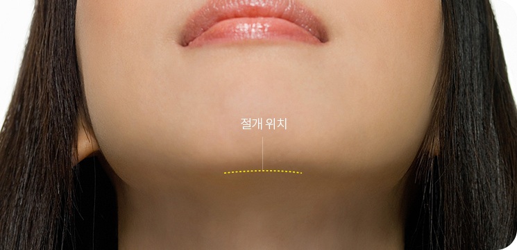 턱밑 주름을 따라 잘 보이지 않는 위치에 절개선을 표시한 사진