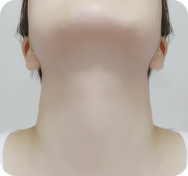 수술 후