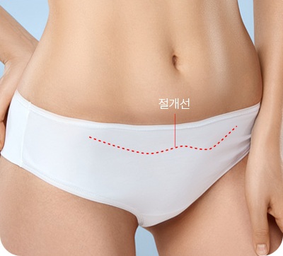 속옷 안쪽으로 가려지는 절개선 위치를 표시한 사진