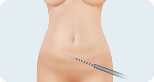 지방흡입술로 복부 지방을 흡입하는 모습