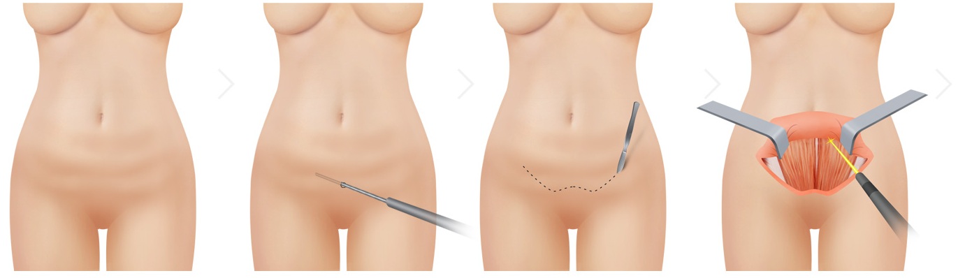 미니 뱃살거상술 1단계 — 수술 전부터 피부 박리까지
