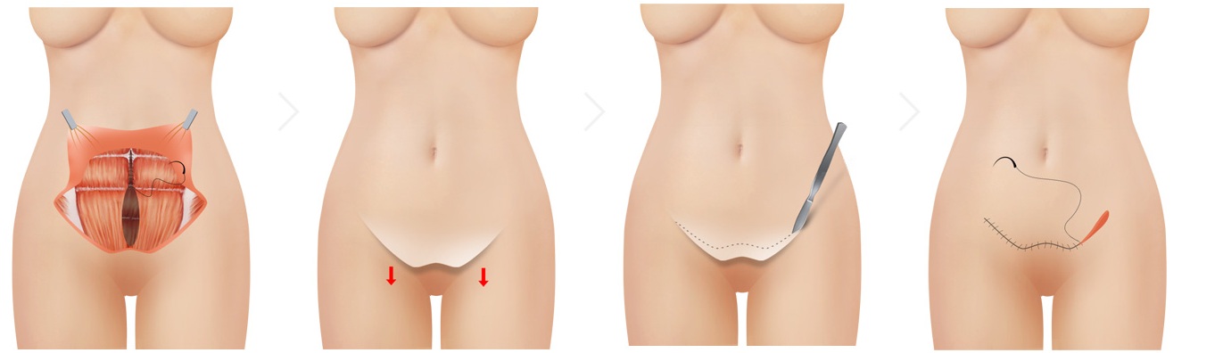 미니 뱃살거상술 2단계 — 복근 봉합부터 절개선 봉합까지
