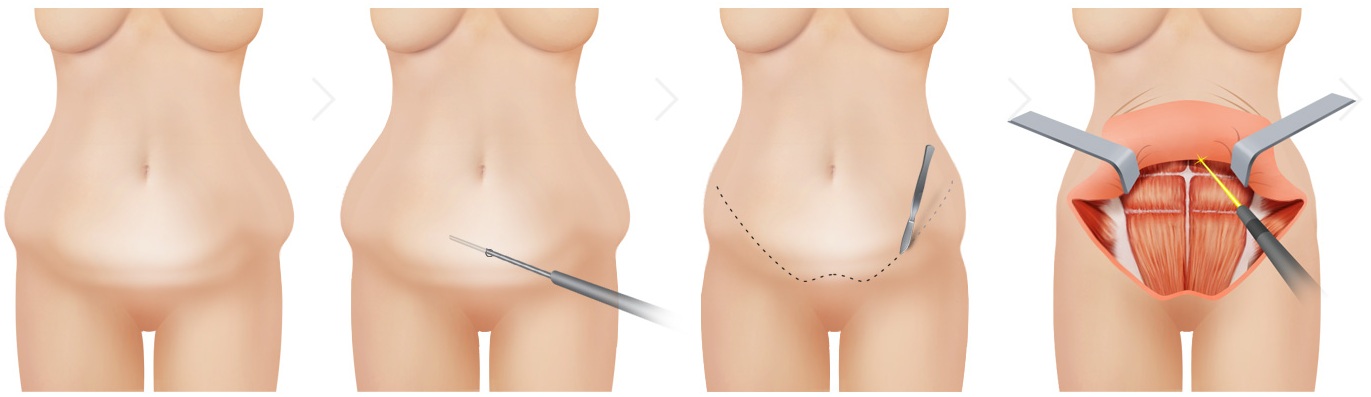 뱃살거상술 1단계 — 수술 전부터 피부 박리까지