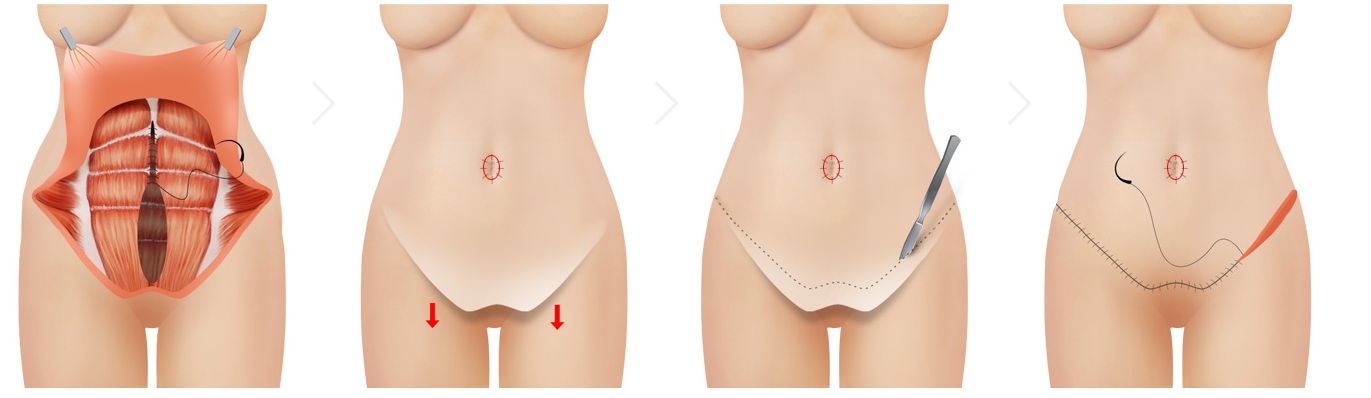 뱃살거상술 2단계 — 복근 봉합부터 절개선 봉합까지