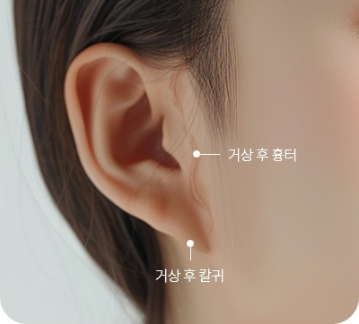 거상 후 발생한 칼귀와 심한 흉터를 교정한 사진