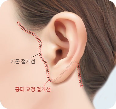 흉터 교정 절개선을 표시한 디자인
