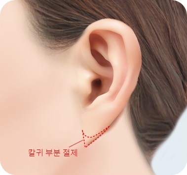 칼귀 부위 절제선을 표시한 디자인