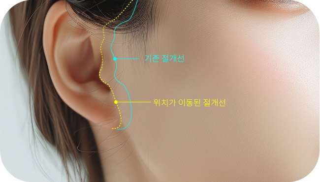 앞쪽에 있어 눈에 띄는 기존 절개선