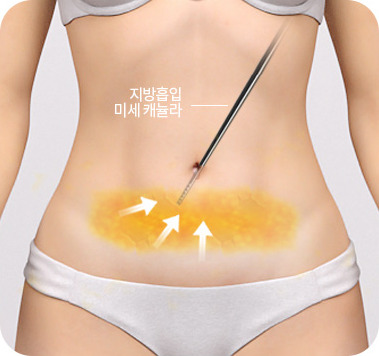 미세한 캐뉼라를 이용한 지방 채취