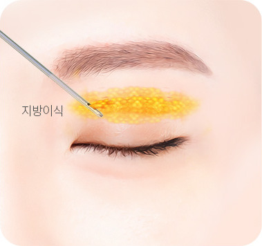 추가적으로 나노 지방이식 시행 (필요시)