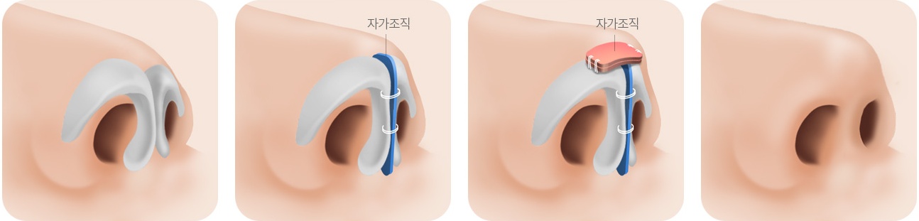 코끝을 많이 높이는 수술 단계