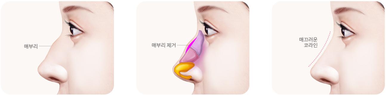 심하지 않은 매부리코 교정 단계 — 수술 전, 매부리 제거, 수술 후