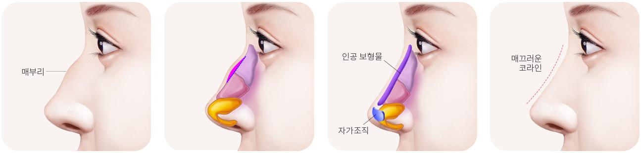 낮은 매부리코 교정 단계 — 수술 전, 매부리 제거, 보형물로 콧대·코끝 보충, 수술 후