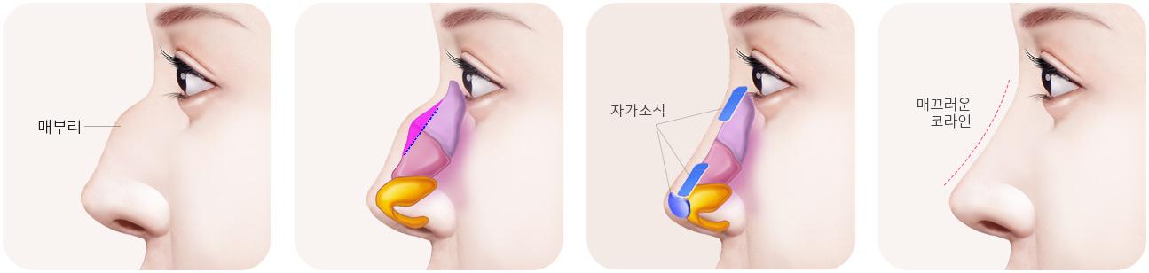 심한 매부리코 교정 단계 — 수술 전, 매부리 제거, 보형물로 콧대·코끝 보충, 수술 후