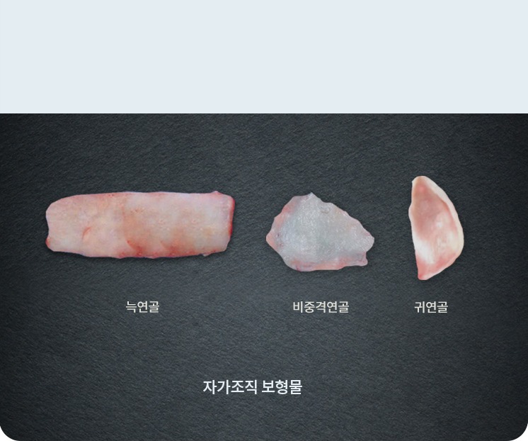 자가조직 보형물 — 늑연골, 비중격연골, 귀연골