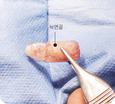 풍부한 양과 견고한 지지력의 늑연골