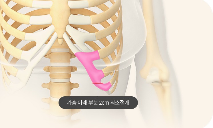 가슴 아래 부분 2cm 최소절개로 늑연골을 채취하는 모습