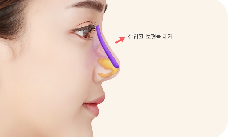 코에 삽입된 보형물을 제거하는 모습
