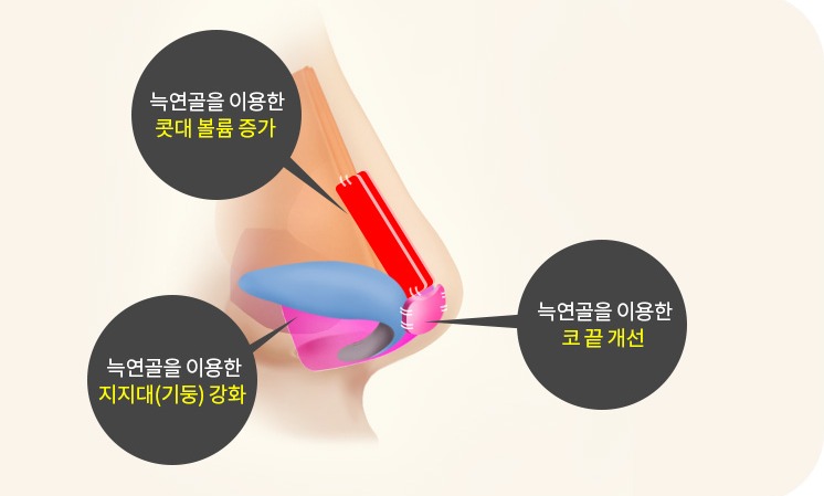 늑연골을 이용한 콧대 볼륨 증가·지지대 강화·코 끝 개선