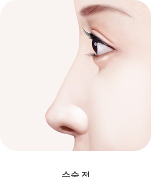 수술 전 — 낮은 콧대와 코끝