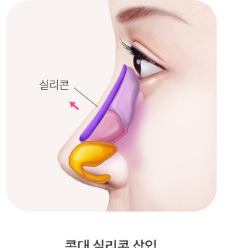 콧대 실리콘 삽입