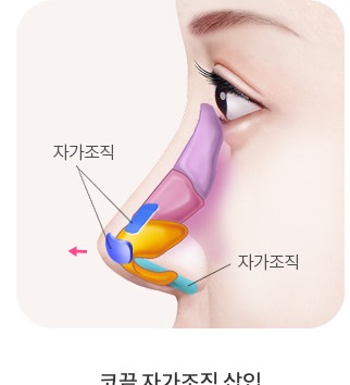 코끝 자가조직 삽입