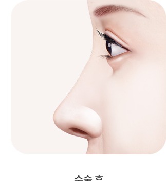 수술 후 — 개선된 코라인
