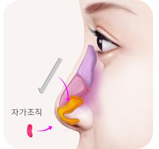 자가조직 삽입