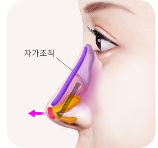콧대, 코끝, 콧날개 교정