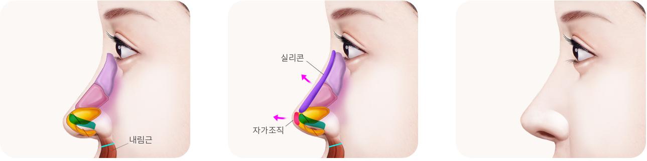 긴코 교정 단계 — 코 끝 내림근 절제, 콧대·코 끝 추가 삽입, 수술 후