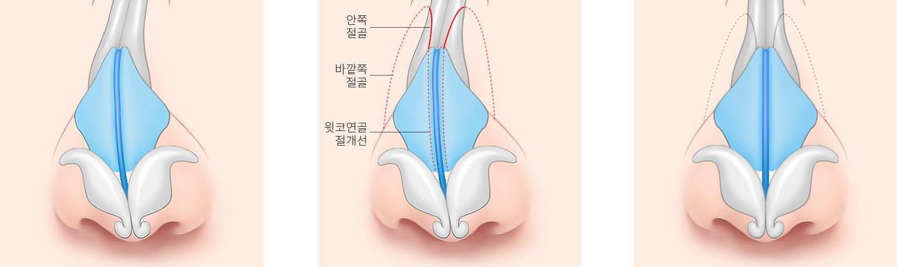 코뼈 절골 교정 단계 — 수술 전, 안쪽·바깥쪽 동시 절골, 수술 후